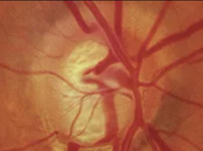 Core Ophthalmic Knowledge for Glaucoma