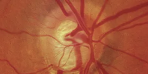 Core Ophthalmic Knowledge for Glaucoma