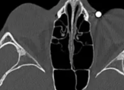 Imaging Acute Ophthalmic Trauma