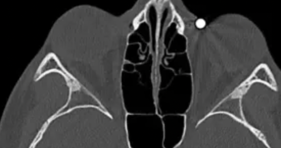 Imaging Acute Ophthalmic Trauma