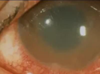 Core Ophthalmic Knowledge for Uveitis