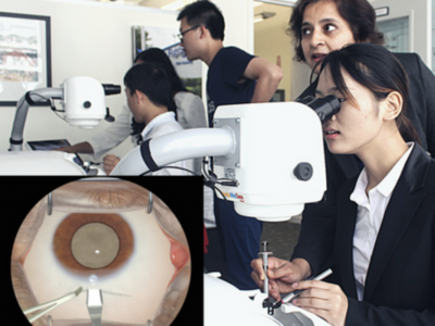 Manual Small Incision Cataract Surgery (MSICS)