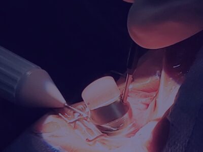 Glaucoma Surgery Premium Course