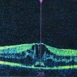 Interpretation of Optical Coherence Tomography (OCT)